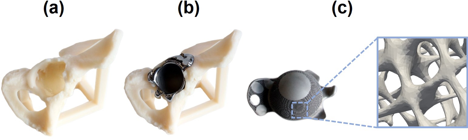 Demonstration of the simplified patient-specific acetabular implant used in the current study to demonstrate the developed computational workflow, which assumed to have a porous structure on its back made from biodegradable metals, a) the large bone defects in the hip bone, b) the implant used for fixing the problem in the total hip arthroplasty surgery, c) the porous structure on the back of the implant, which is assumed to be biodegradable for demonstration purposes. This part is made from non-degradable materials in real-case scenarios to provide support to the patient-specific degradable part attached to it (Fig. 