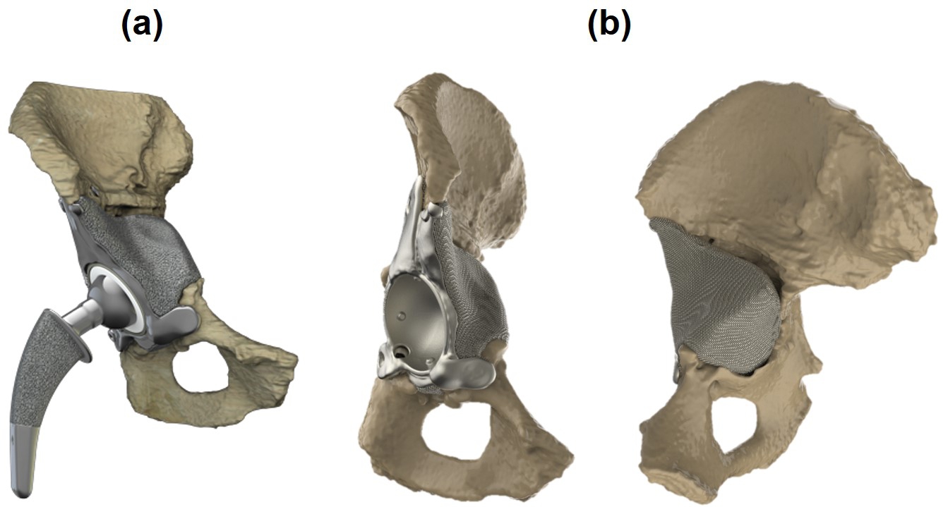 Demonstration of patient-specific acetabular implants in large bone defects (reproduced with permission from Ortho Baltic Implants Co.