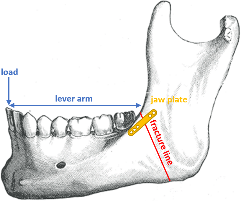 Mandible with indication of fracture line, jaw plate, lever arm and load